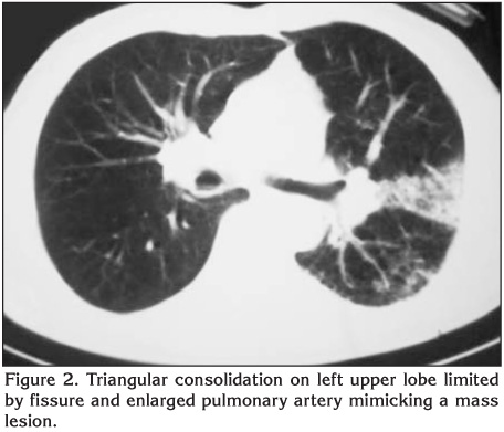 Community acquired Burkholderia cepacia pneumonia a report of two