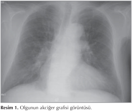 Kronik akciğer hastalığında pulmoner hipertansiyon