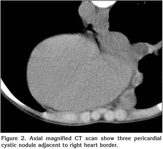 Multiple mediastinal hydatic cyst: a case report