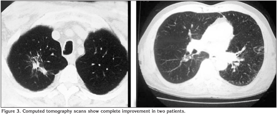 Community-acquired Burkholderia cepacia pneumonia: a report of two ...