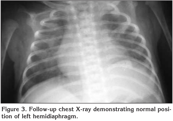 Phrenic nerve injury due to thoracentesis for TPN effusion in a preterm ...