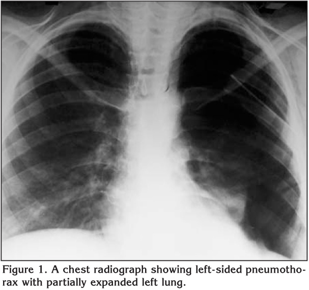 Spontaneous pneumothorax in pregnancy: a case report