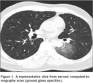 Massive hemoptysis, the etiology is aorto-bronchial fistula